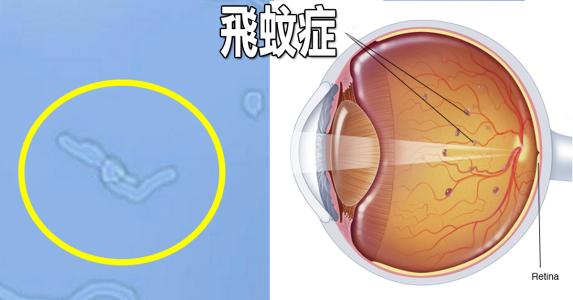 飞蚊症症状 常见飞蚊形状图片 黑丝 絮状物 2026